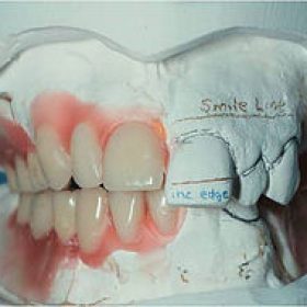 dentures brisbane north