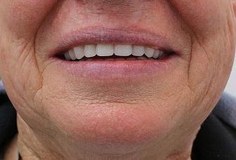 Partial Denture Treatment Online