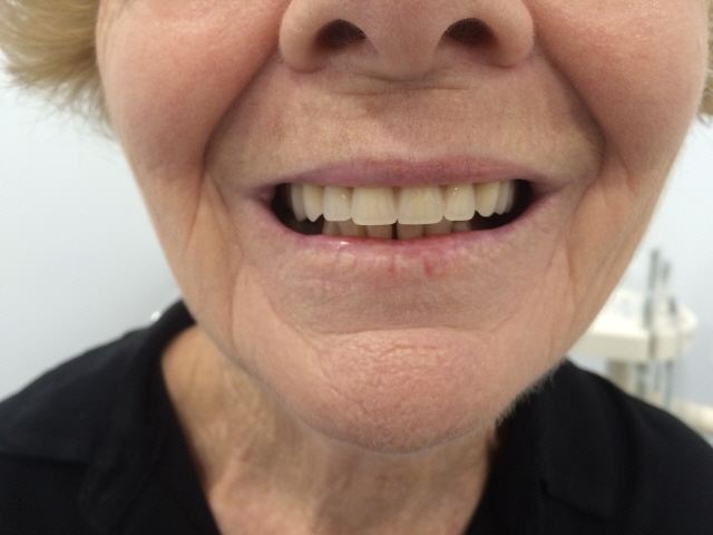 Broken Denture Repair | Dental Veneers Cashmere