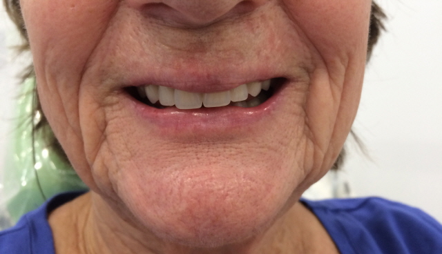 Partial Denture Therapy