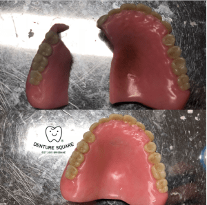 denture dentures