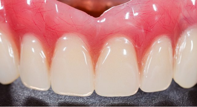 Benefits of Permanent Dentures
